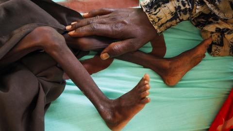 Kenia, Dadaab: Eine Mutter legt ihre Hand auf das Bein ihres stark unterernährten Sohns in einem von der Gesellschaft für Internationale Zusammenarbeit geführten Krankenhaus.
